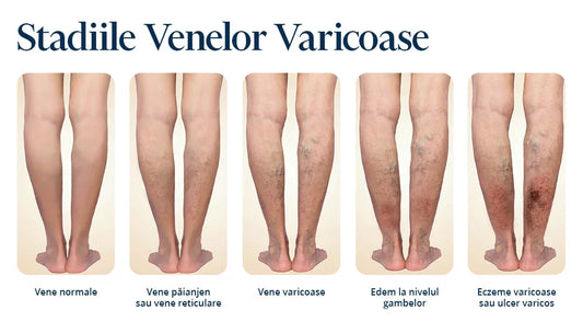 Leacuri Bătrânești pentru Varice